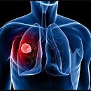 Торакальная хирургия